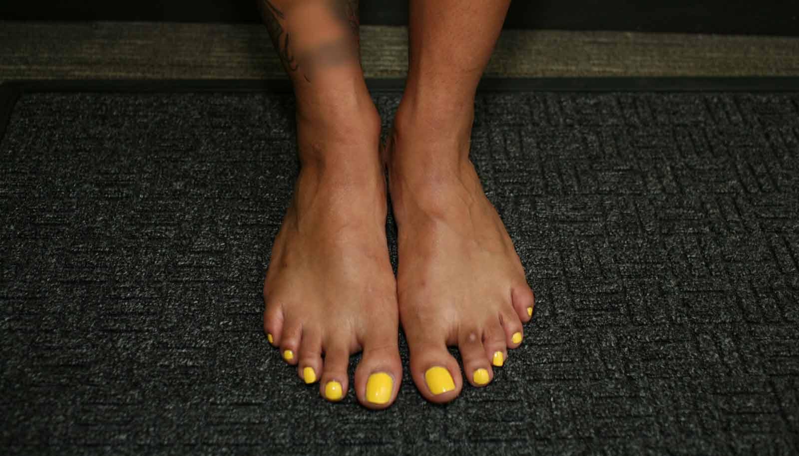 yellow toenails